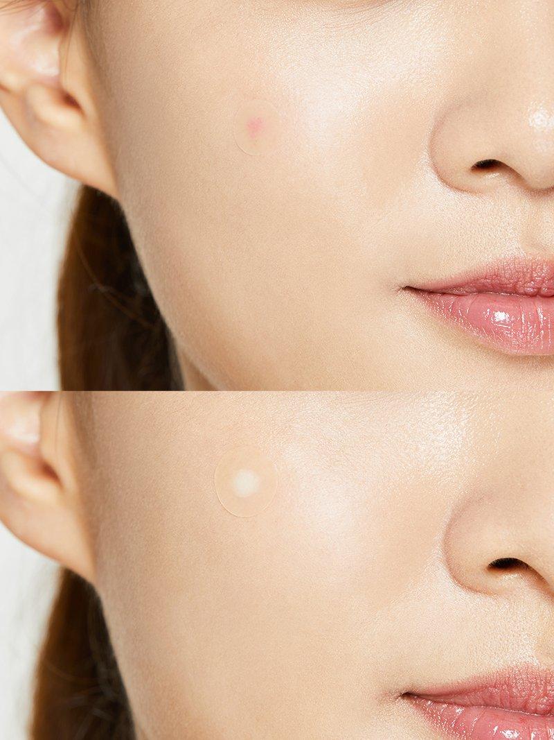 Korean Cosmetics | Acne Pimple Master Patches